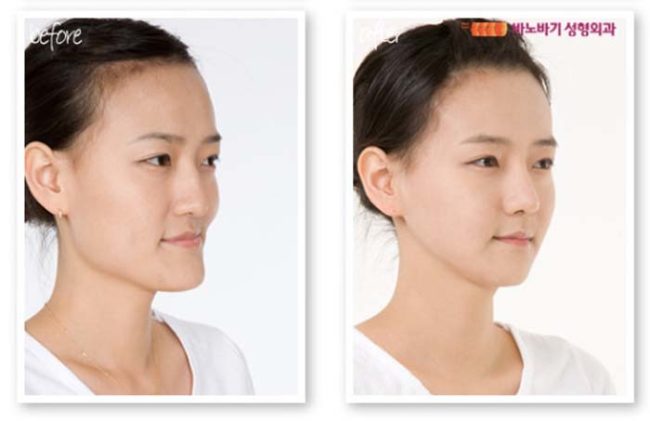 Chin surgery has taken off with South Korean women over the past few years in an effort to adhere to strict standards of beauty. It involves shaving away parts of the jaw to create a more tapered appearance.