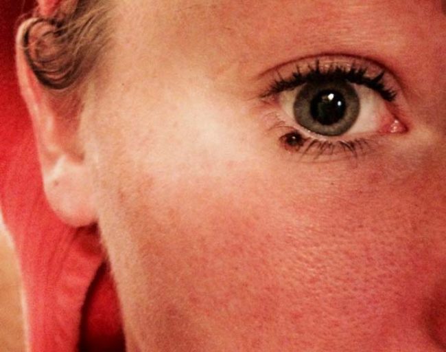 Yes, ticks can also take up residence under your eyes.