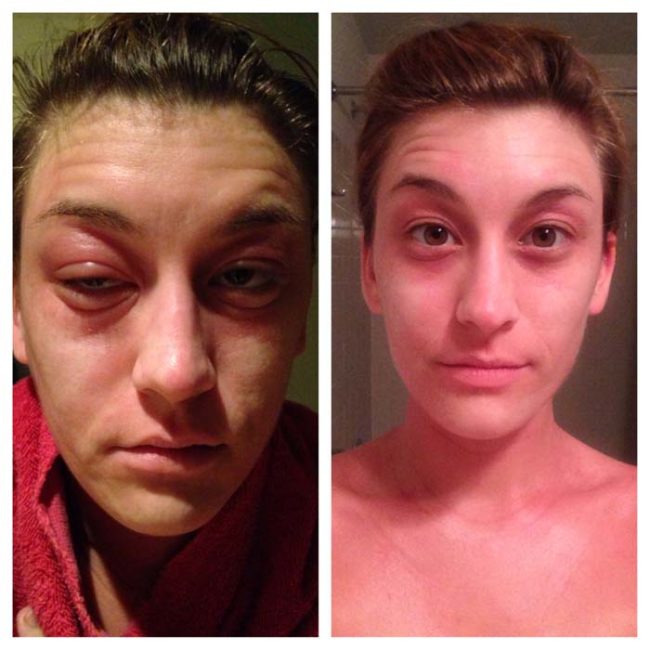 Before and after treatment for a severe allergic reaction...two hours apart.