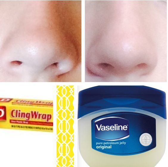 Put some Vaseline on blackheads and cover the spot with plastic wrap. After about 15 minutes, remove it, and rinse -- you should be looking clear!