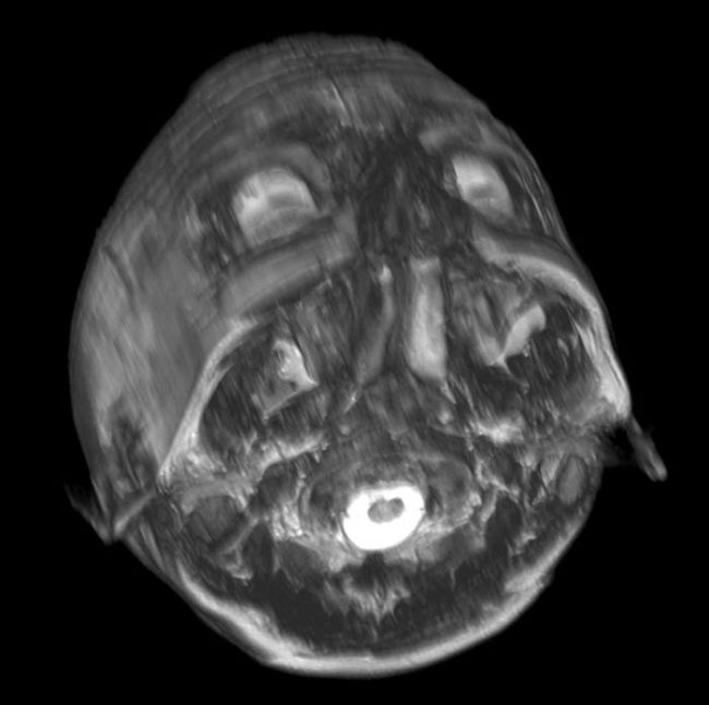 Then you can take the 2-D images from the MRI data and combine them to create 3-D versions.