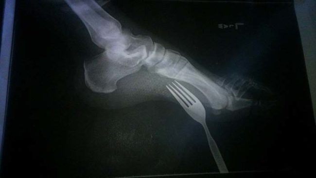 Nothing like getting a fork stuck in your foot. Great times!