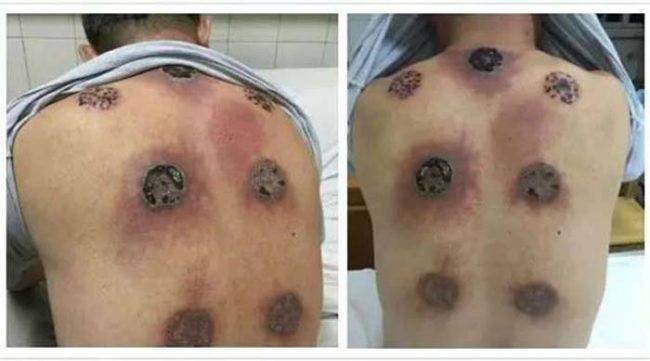 It's a lesson that a man from Sichuan, China, learned the hard way. Below is a photo of his back taken at a hospital after the 63-year-old underwent daily sessions of cupping for an entire month.