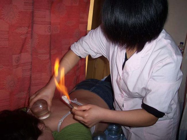 The process involves a fuel-soaked cotton ball being lit on fire. In one fluid motion, the flame is placed inside the glass cup and the cup is placed on the skin. By removing the oxygen, it creates a tighter seal.