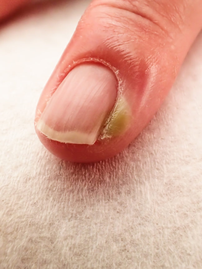 Dealing with nail fungus? No problem. Let mouthwash help you out. Mix equal parts vinegar and mouthwash, soak a cotton ball, and apply to every funky nail. Use a different cotton ball each time.