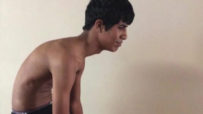 Meet Muntathar Altaii, a teenager suffering from excruciating pain caused by a failed attempt at removing a tree root from his backyard.