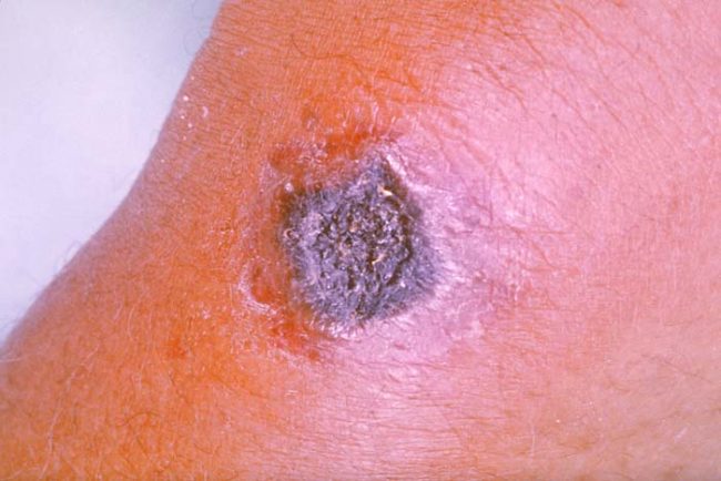 Anthrax is typically spread through contact with the bacteria's spores. Upon contact with the skin, they can create lesions. The spores can also be inhaled and ingested, which together can cause severe health complications. There is a vaccine for the disease, but for those already infected, early treatment with antibiotics is essential.