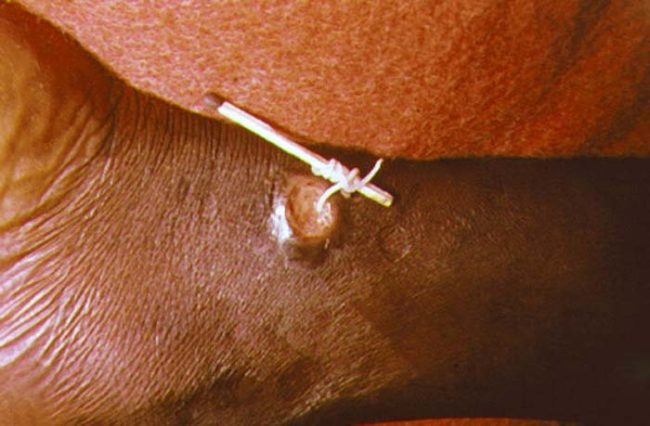 Guinea worm