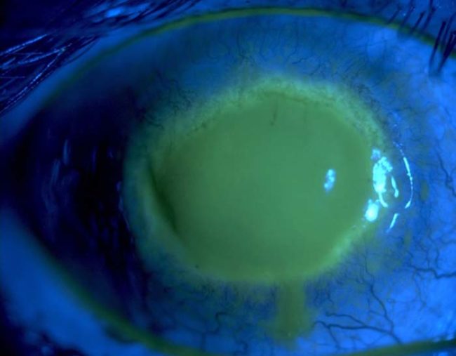 Acanthamoeba Keratitis