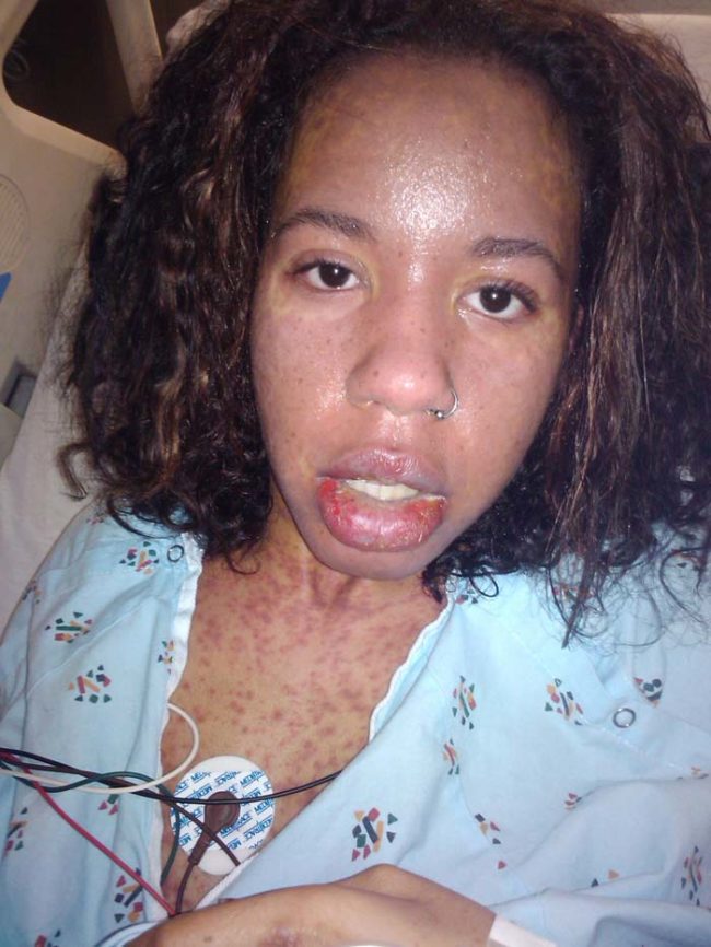 Here she is in the hospital just after being diagnosed with TEN. In her story, she does mention the medications that caused it, but this reaction is not limited to any particular medications.