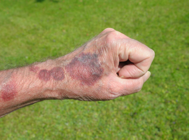 Darker bruising is much more serious and may require medical attention.