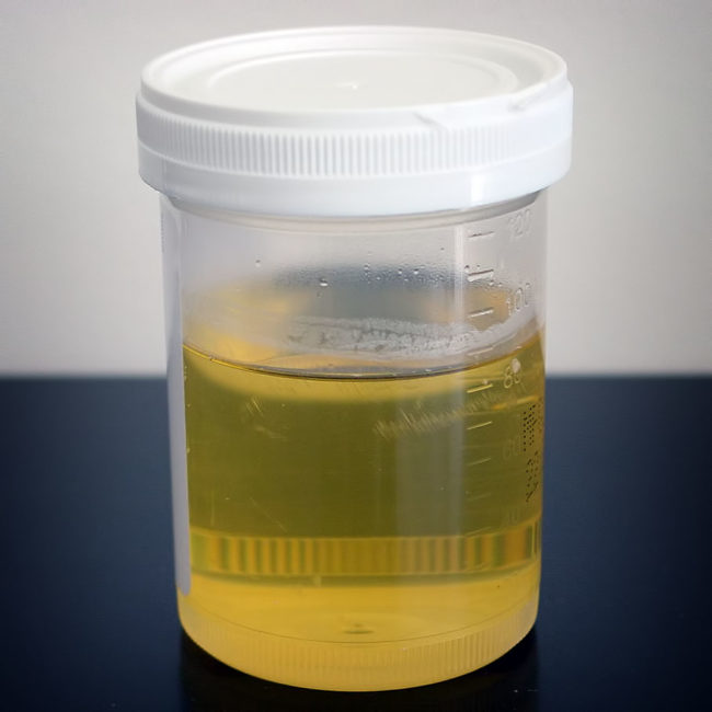 Some celebrities use urine therapy, or urotherapy, for a supposedly wide range of health benefits, including immunization against allergies and treatment of calluses.  This involves rubbing your own urine on your skin or even drinking it.  However, there is no scientific evidence that proves it is therapeutic.