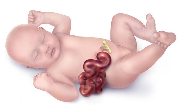 Doctors prepared them for the worst. The horrible effect of gastroschisis looks something like the illustration below. 