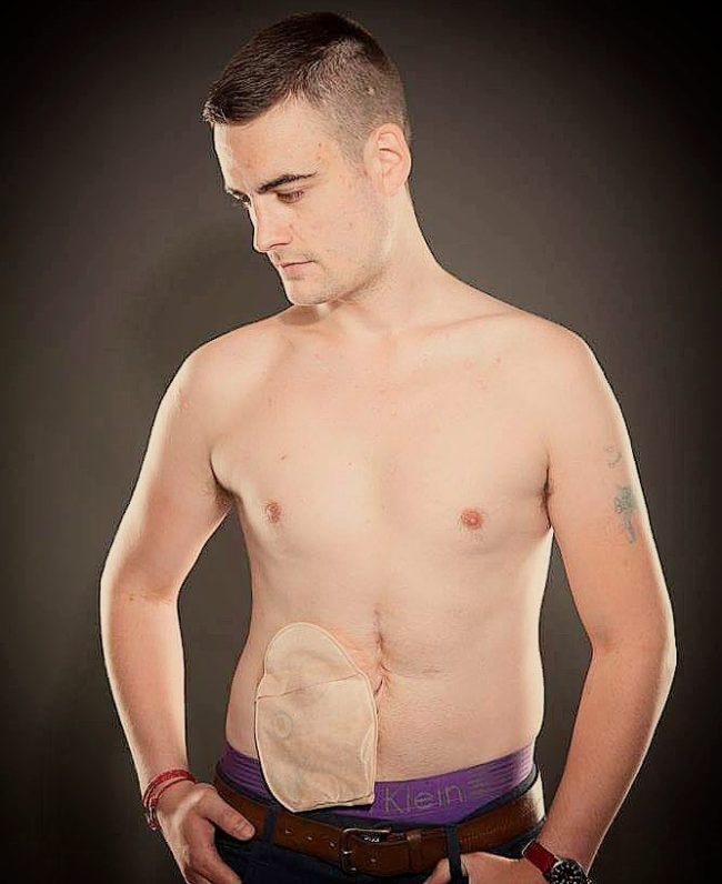With clothes on, he seems "normal."  But when he takes off his shirt, you can clearly see his Hickman line and stoma bag connected to his <strong></strong>ileostomy<strong></strong>.