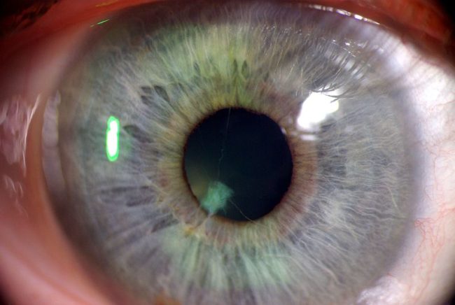 The membrane strands exist in order to provide blood to your lens. The threads can connect to the cornea or lens, but usually they run from one portion of the iris to another.