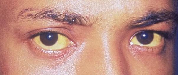 Yellow whites of eyes