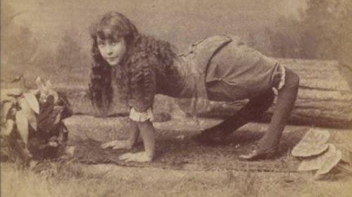 The first documented accounts of the deformity go back to the early 1800s.  In 1886, a girl named <a href="https://en.wikipedia.org/wiki/Ella_Harper" target="_blank">Ella Harper</a> was featured in a circus and called "The Camel Girl" because she walked on all fours.