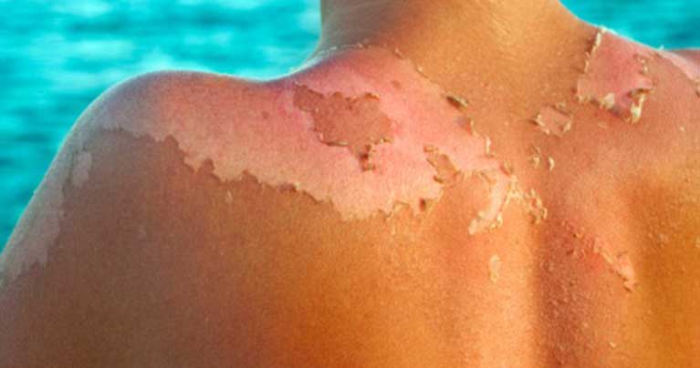 Does Sun Make Melanoma Worse Ouestny